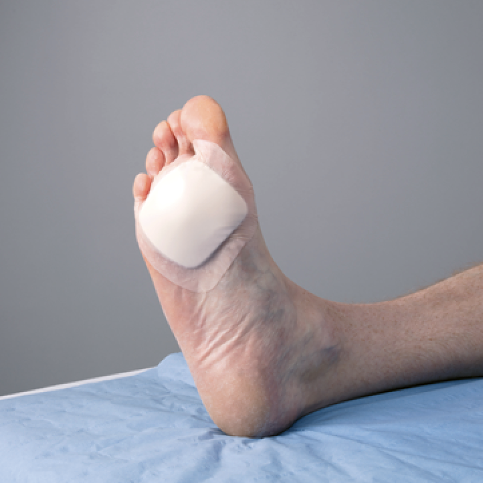 Convatec AQUACEL Foam Pro toegepast op bal van de voet